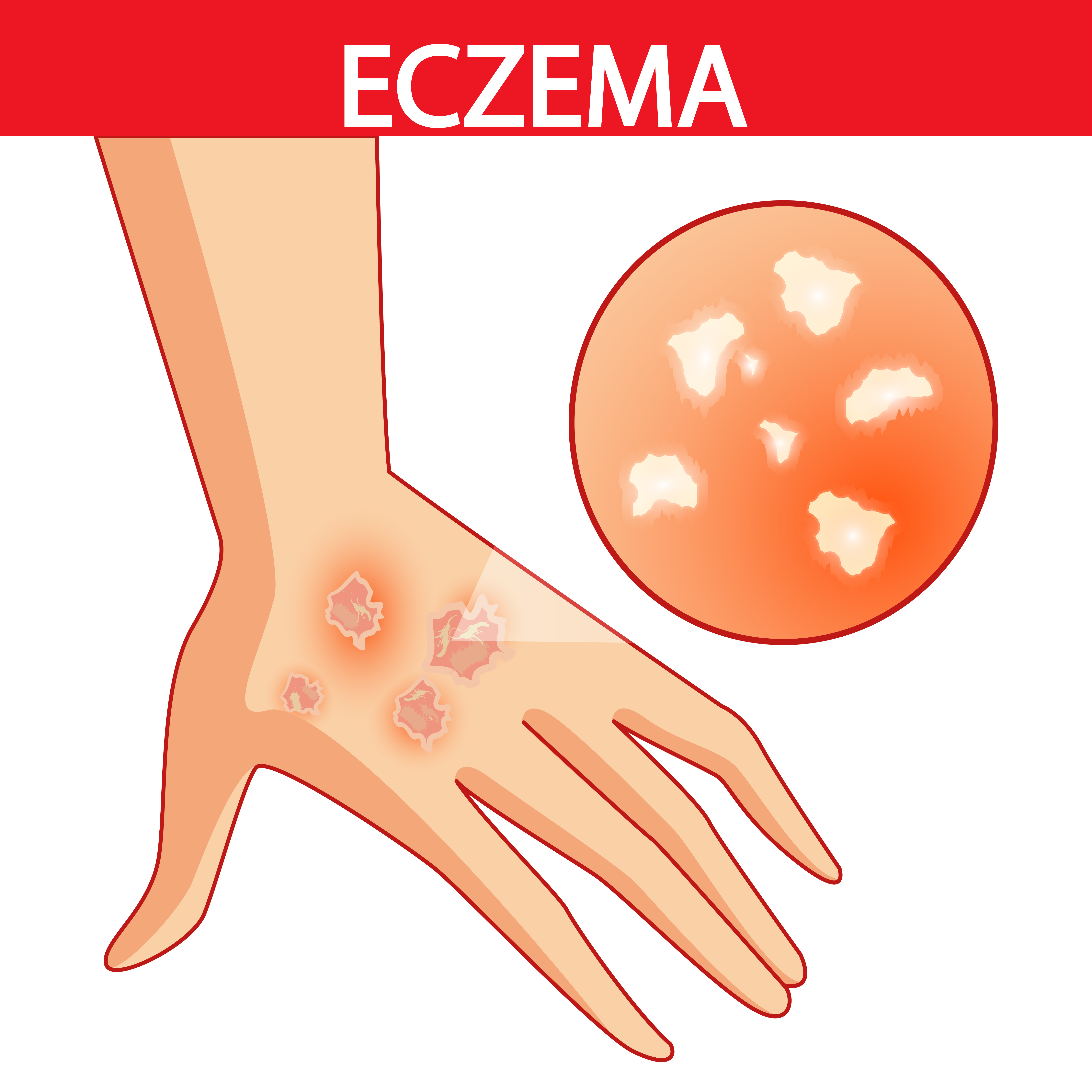 Atopic Dermatitis or Eczema