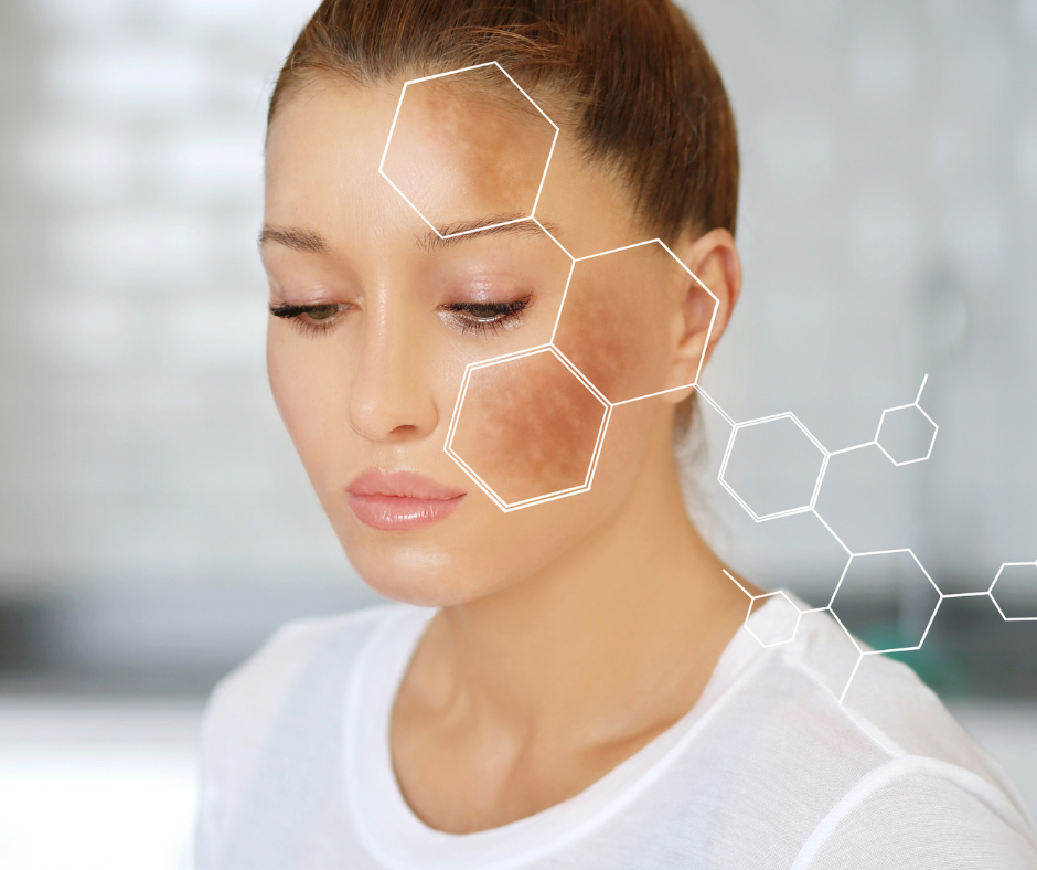 acne hyperpigmentation