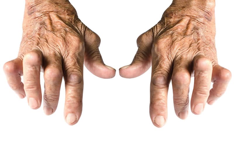 Rheumatoid Arthritis of the Hands