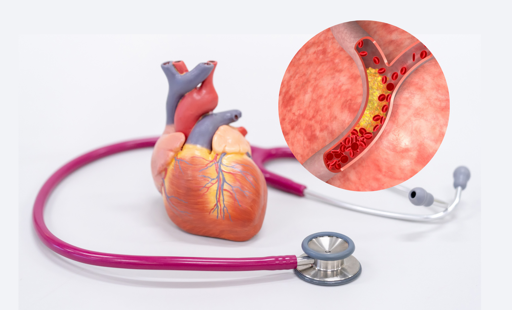 Dyslipidemia D7960C00012 landing page pic